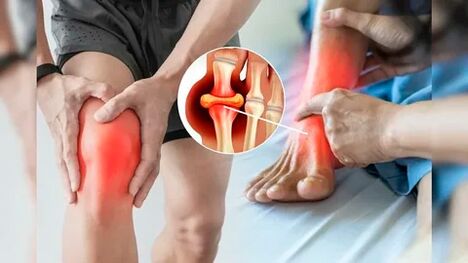 Icexin gela aplikatzeko egokiak diren larruazaleko eremuak (belaunak, ukondoak, bizkarrean)