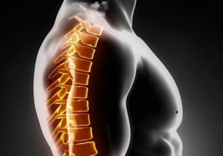 Torazeko osteocondrosis mina eta ondoeza bizkarreko erdialdean batera